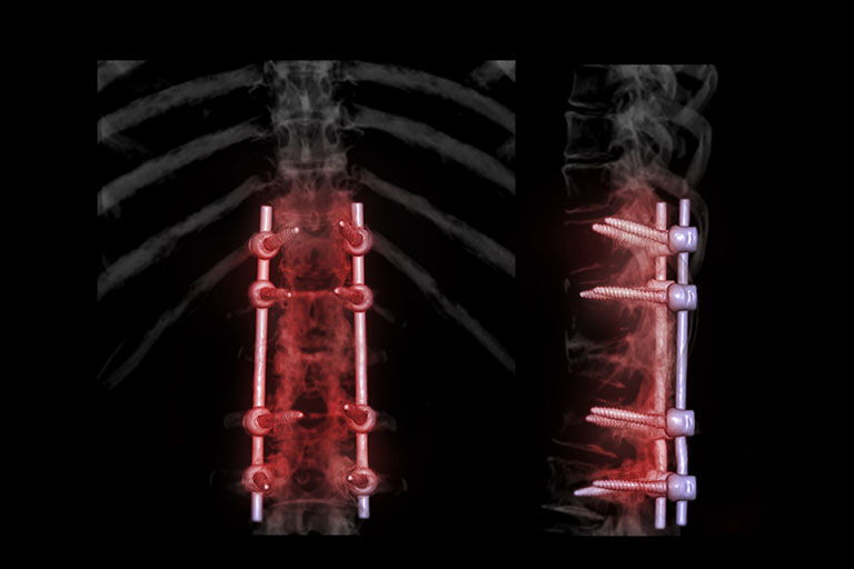 lumbar spine surgery with dr. travis washington